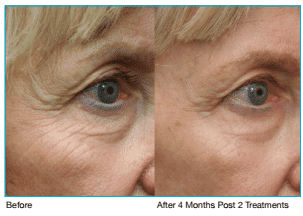 Before and After Pelleve Skin Tightening Fort Worth TX