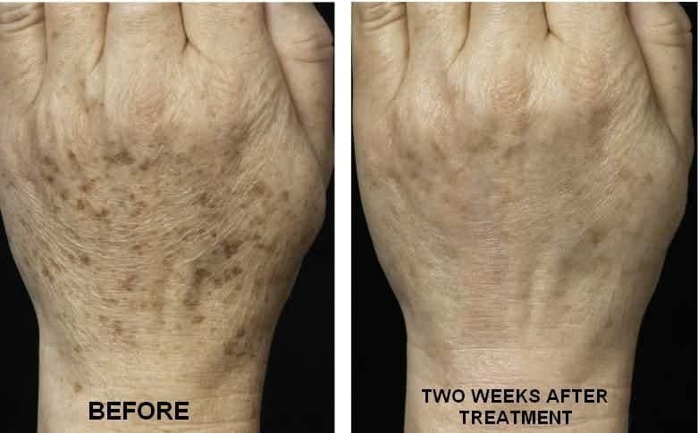 Before and After Skin Rejuvenation Fort Worth TX
