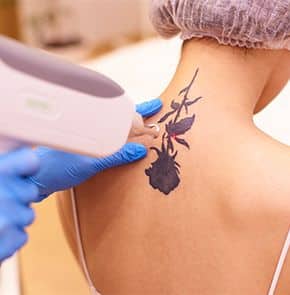 TO Tattoo Removal with PicoSure Laser