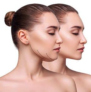 Warm Sculpting Treatment Fort Worth TX