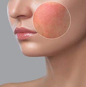 srvcs FacialVeins Rosacea