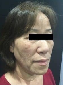 After Image: PicoSure Focus