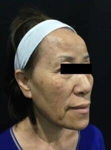 Before Image: PicoSure Focus