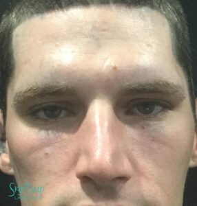 After Image: PicoSure Laser Tattoo Removal