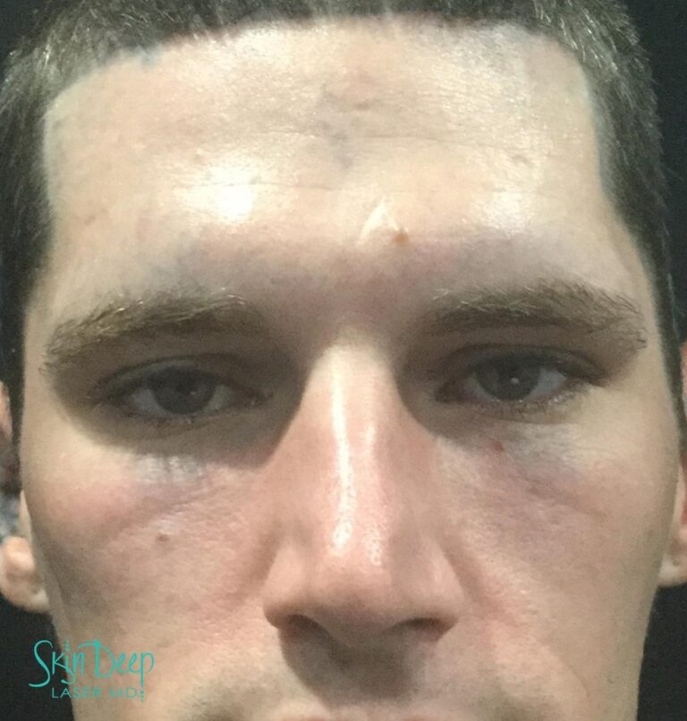 After Image: PicoSure Laser Tattoo Removal - front