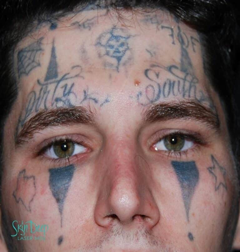 Before Image: PicoSure Laser Tattoo Removal - front