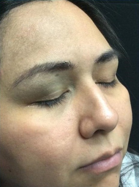 After Image: Nevus of Ota - right-front-oblique