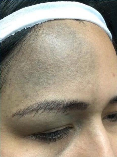 Before Image: Nevus of Ota - right-front-oblique