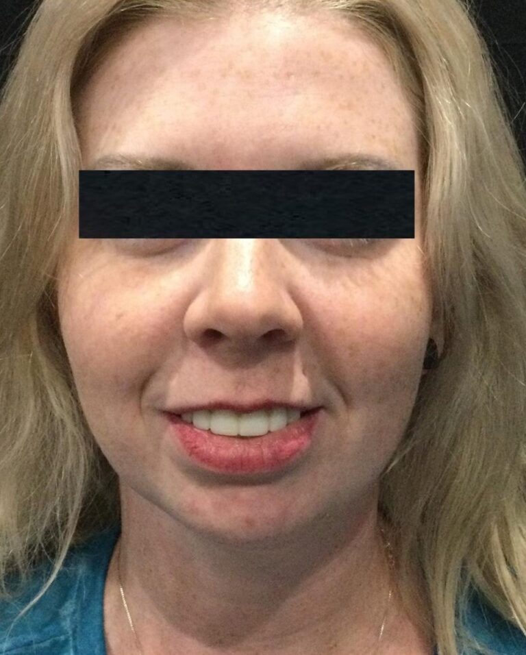 After Image: SculpSure Double Chin Treatments - front
