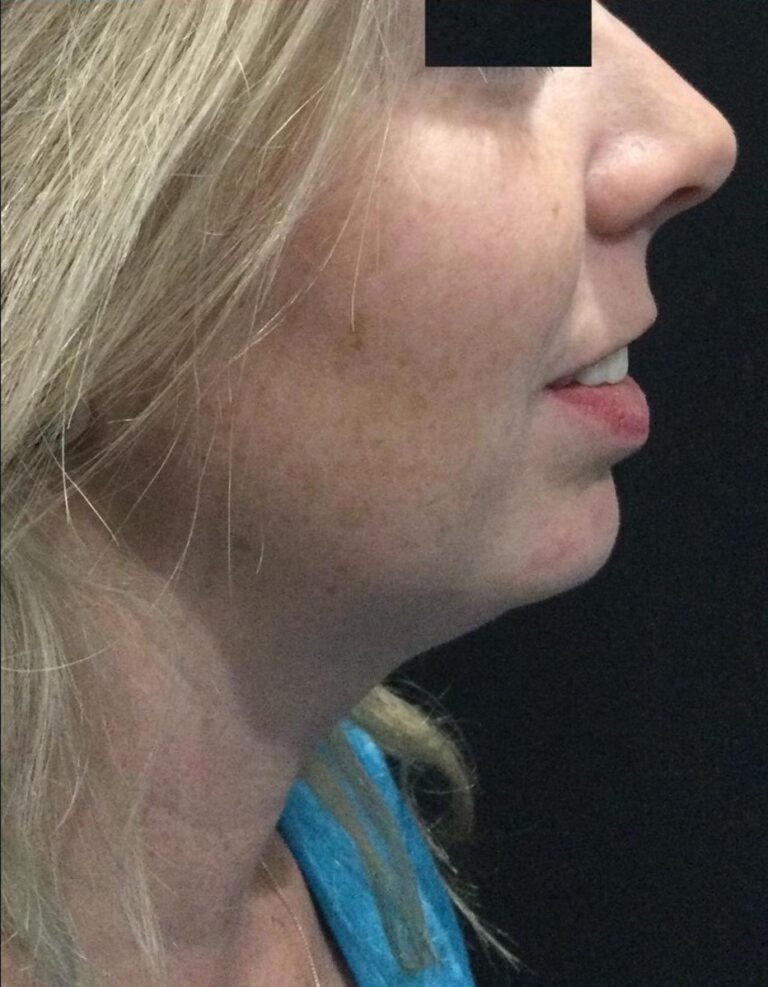 After Image: SculpSure Double Chin Treatments - right-side