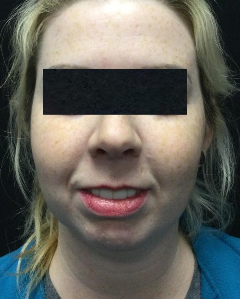Before Image: SculpSure Double Chin Treatments - front