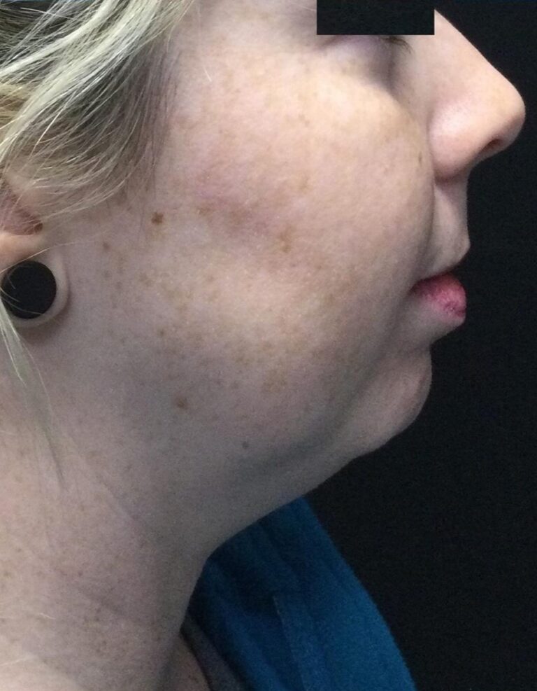 Before Image: SculpSure Double Chin Treatments - right-side