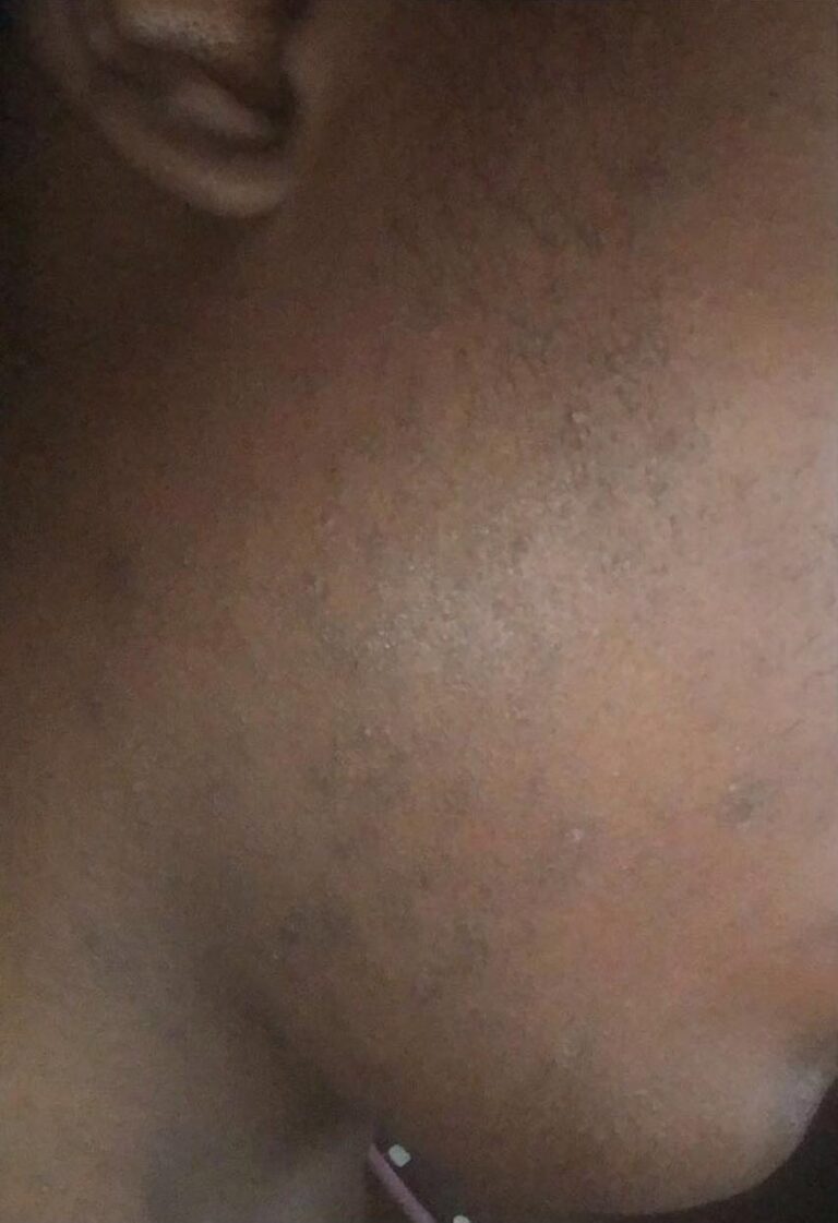 After Image: Series Laser Hair Removal - right-front-oblique