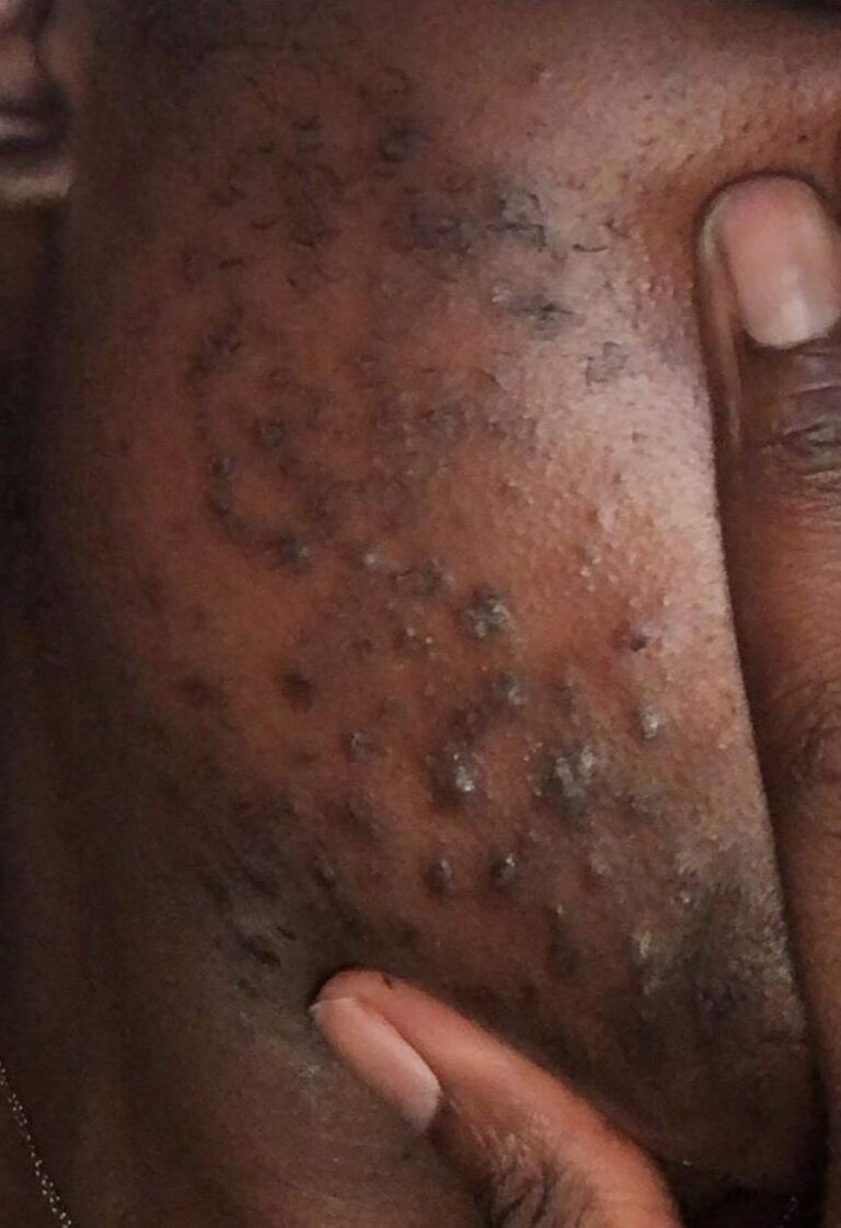 Before Image: Series Laser Hair Removal - right-front-oblique