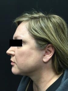After Image: SculpSure Double Chin Treatment