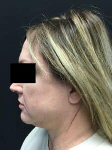 Before Image: SculpSure Double Chin Treatment