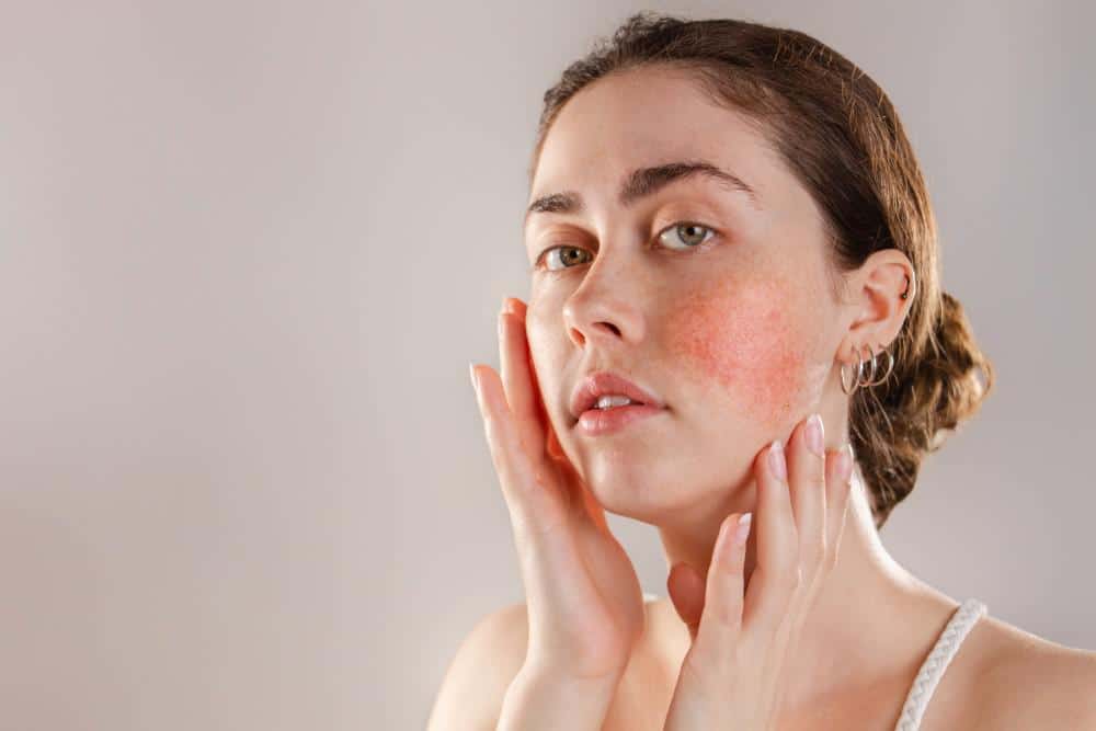 5 Symptoms of Rosacea 65f350113f8eb.jpeg