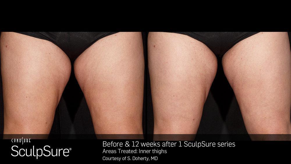 Combat Stubborn Fat with WarmSculpting by SculpSure 65f353183b045.jpeg