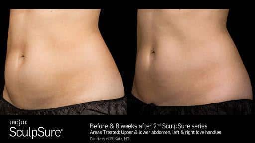 Considering Lipo in Fort Worth? Try WarmSculpting with SculpSure Instead! 65f3552e63758.jpeg