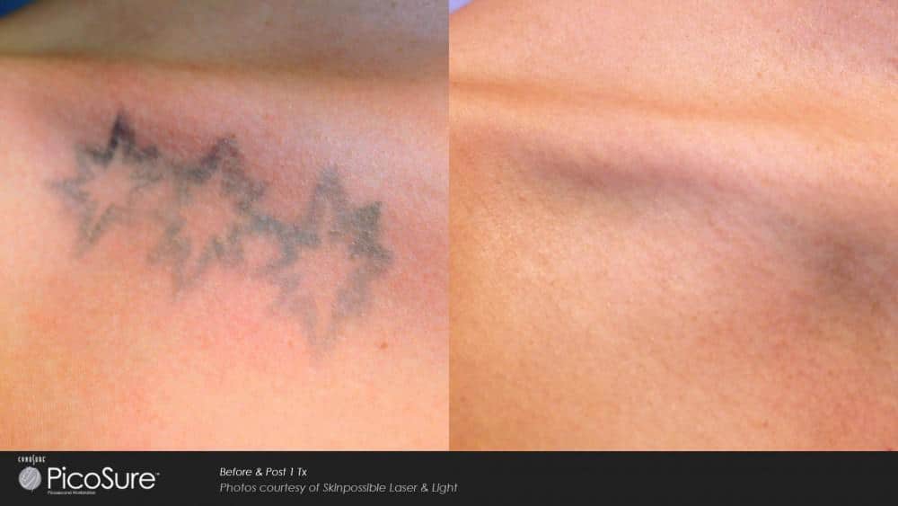 Eliminate Your Old Tattoo with Laser Tattoo Removal 65f354a6575c8.jpeg