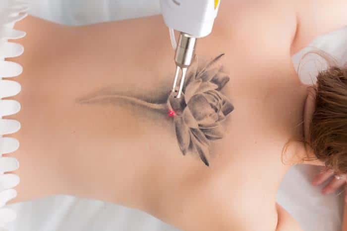 How Does Tattoo Removal Actually Work? 65f356f7da7d9.jpeg