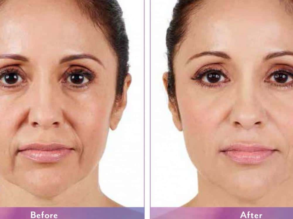 Improve Your Appearance with Juvederm 65f35474844ca.jpeg