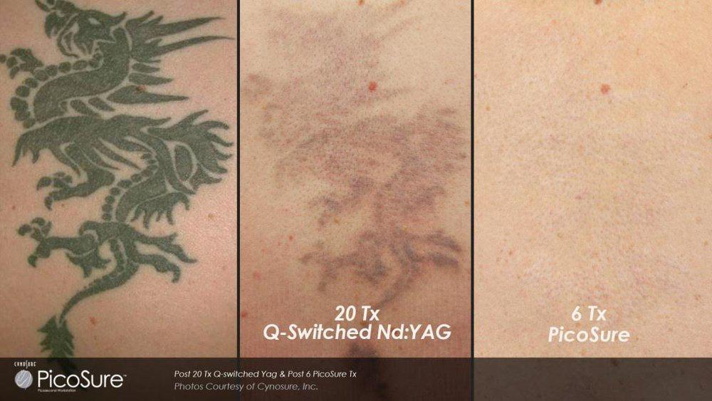 Is PicoSure Tattoo Removal Right for You? 65f35311a7fc0.jpeg