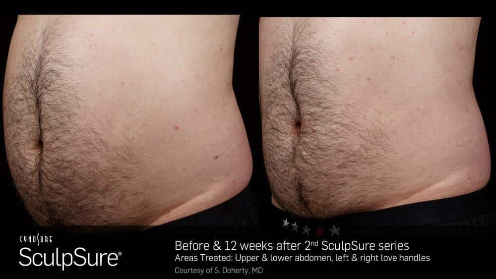 Looking for a Non Surgical Alternative to Liposuction? Try WarmSculpting with SculpSure! 65f352fe353e3.jpeg