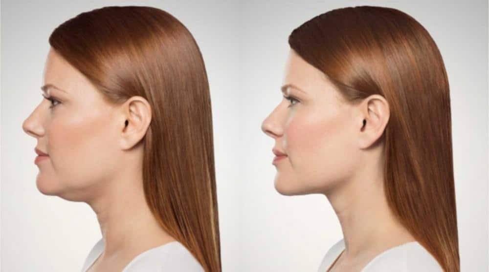 New Treatment to Remove Fat Under the Chin 65f3530a91230.jpeg