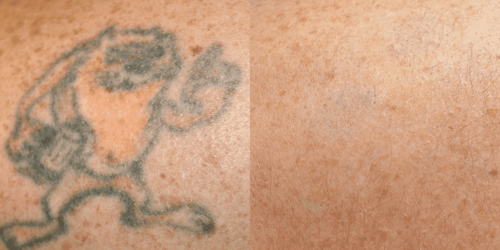 Remove Unwanted Tattoos Safely with PicoSure Laser Treatments 65f353203bf23.png