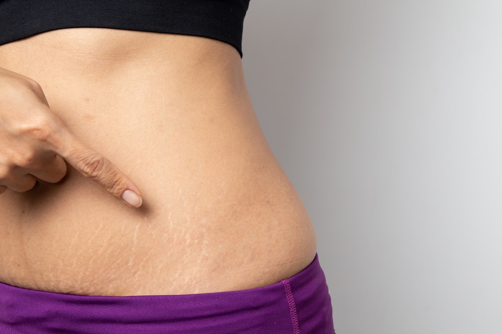 Stretch Marks: Causes, Treatment, and Prevention 65f34e3f51d32.jpeg
