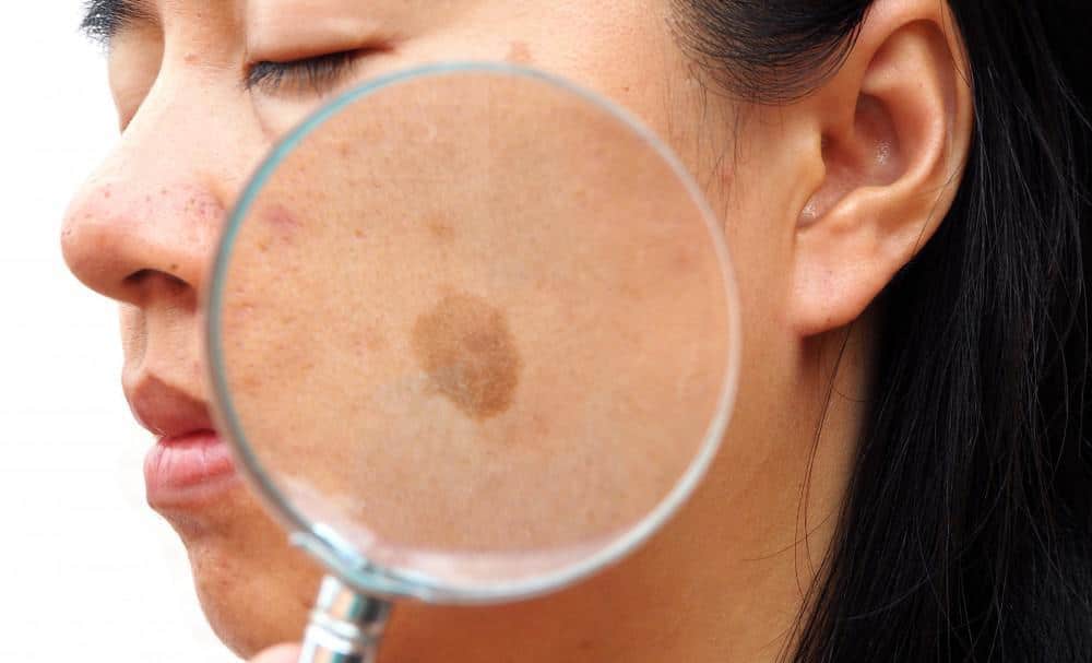 What Causes the Brown Patches of Melasma? 65f3489622b08.jpeg