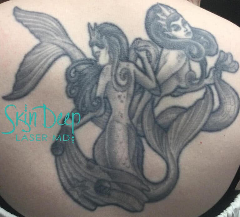 Before Image: Laser Tattoo Removal - front