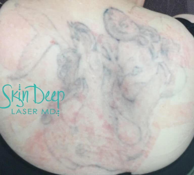 After Image: Laser Tattoo Removal - front