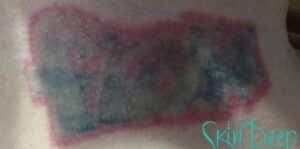 Before Image: Laser Tattoo Removal