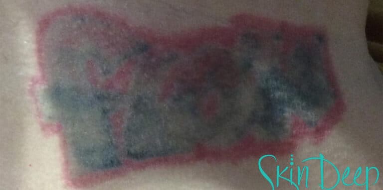 Before Image: Laser Tattoo Removal - front