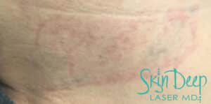 After Image: Laser Tattoo Removal