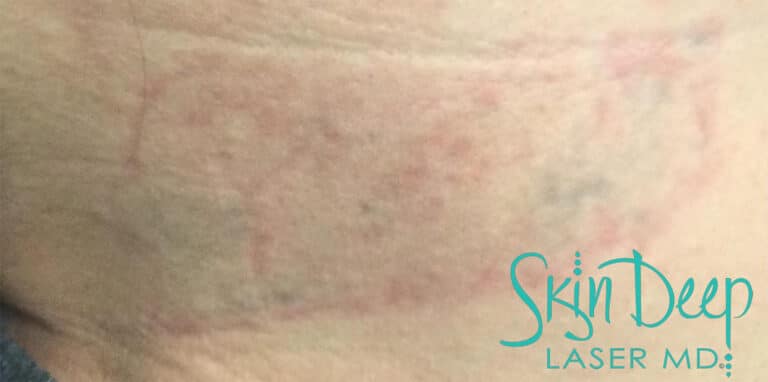 After Image: Laser Tattoo Removal - front