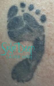 Before Image: Laser Tattoo Removal