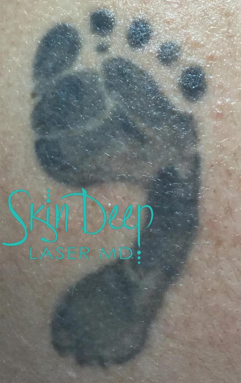 Before Image: Laser Tattoo Removal - front