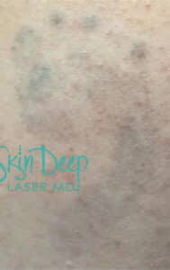 After Image: Laser Tattoo Removal