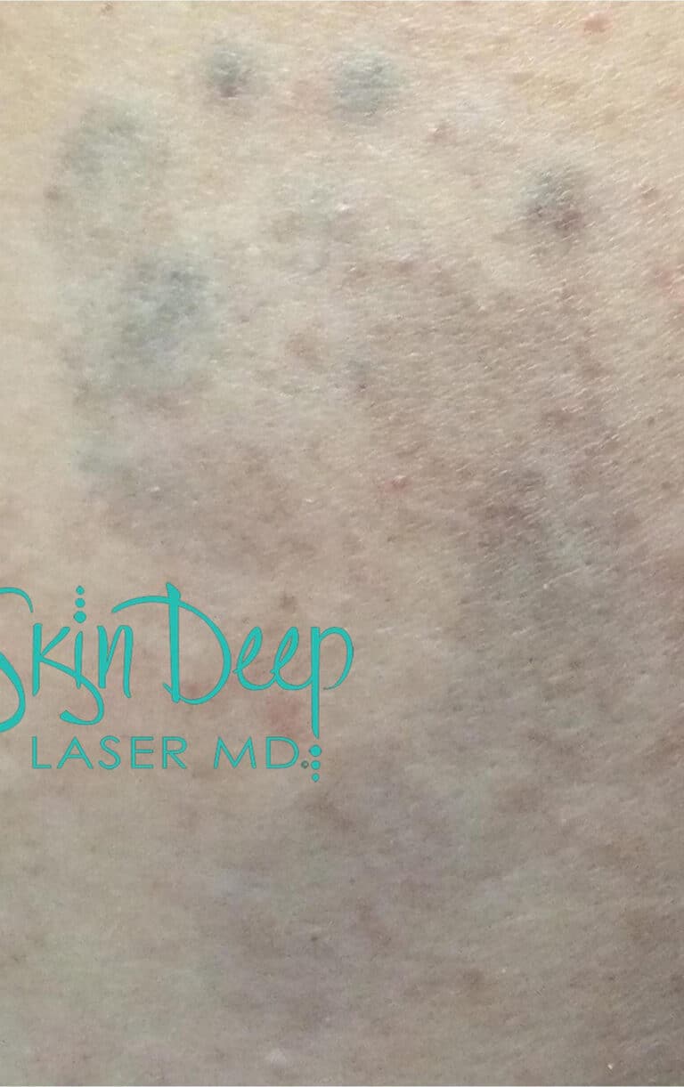 After Image: Laser Tattoo Removal - front