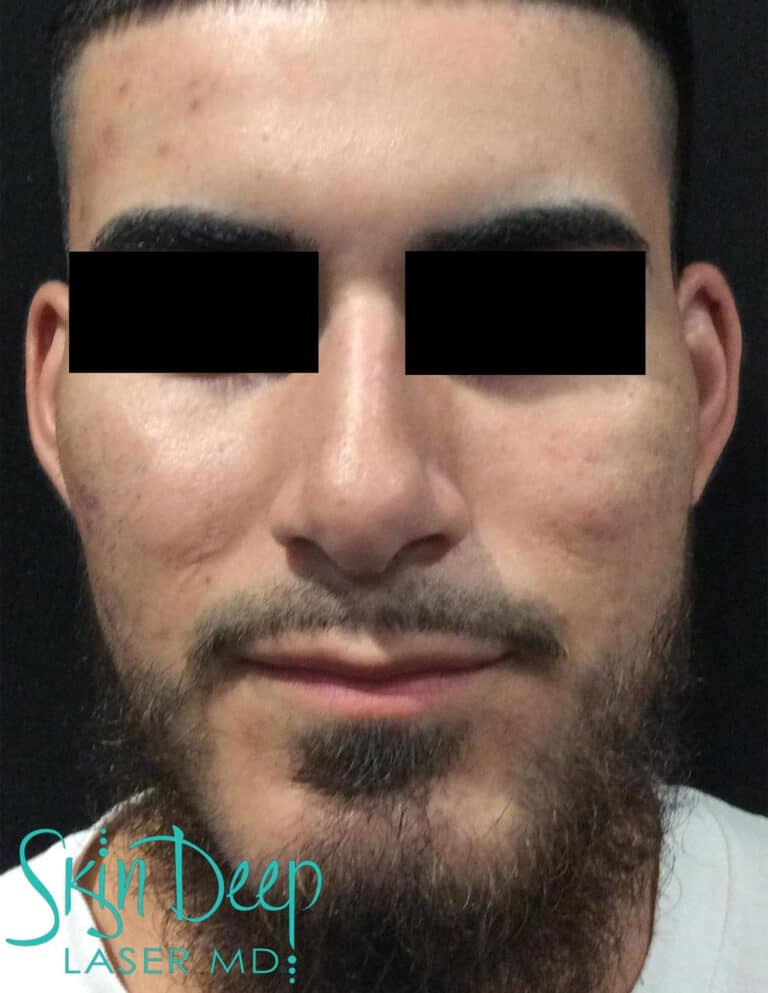 Before Image: Peel - front