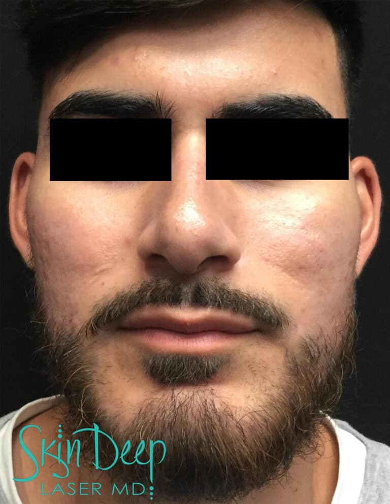 After Image: Peel - front