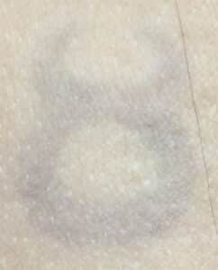 After Image: Laser Tattoo Removal