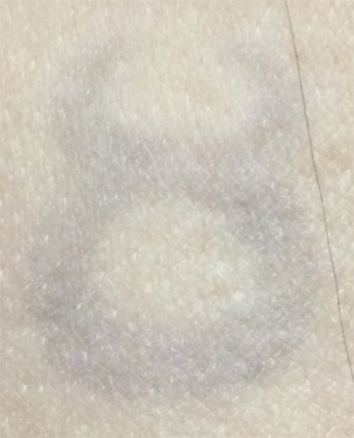 After Image: Laser Tattoo Removal - front