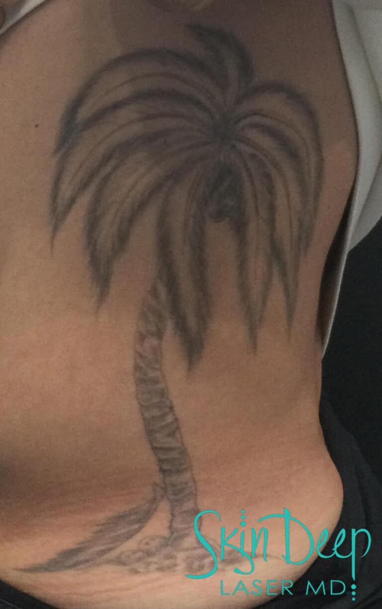 Before Image: Laser Tattoo Removal - front