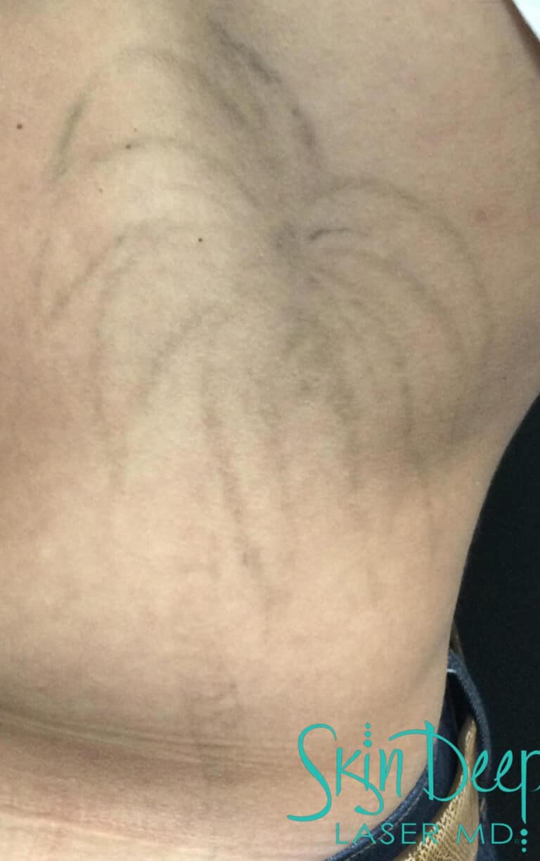 After Image: Laser Tattoo Removal - front