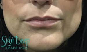 Before Image: Lip Augmentation