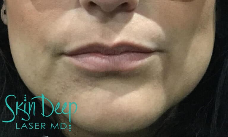 Before Image: Lip Augmentation - front